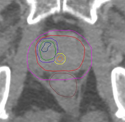 Influence of Urethra Sparing on Tumor Control Probability and Normal Tissue Complication Probability in Focal Dose Escalated Hypofractionated Radiotherapy: A Planning Study Based on Histopathology Reference